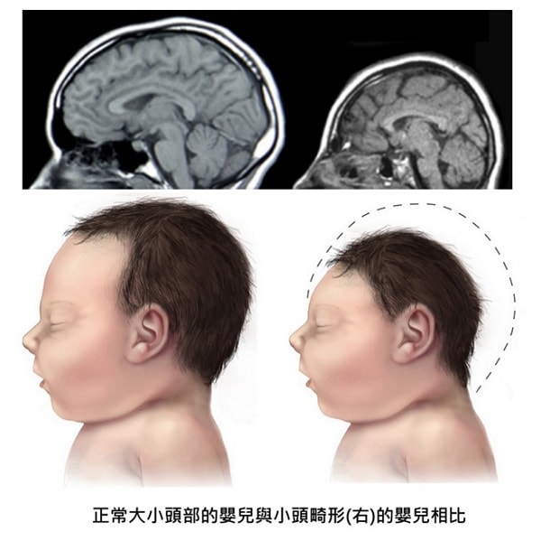 Microcephaly-min (1)