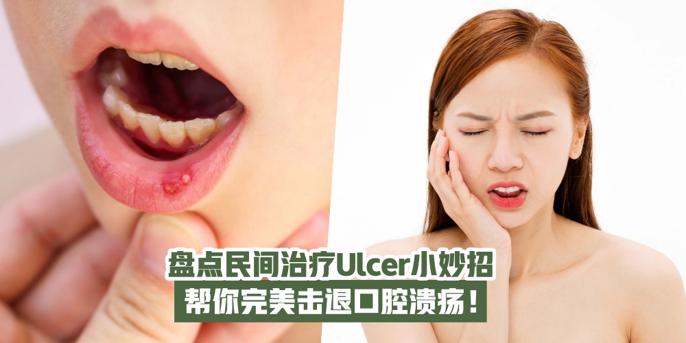 【必收藏！】盘点民间治疗Ulcer的小妙招 · 帮你完美击退口腔溃疡！